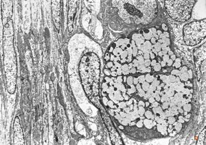 F,31y. | ovary - mucinous carcinoma